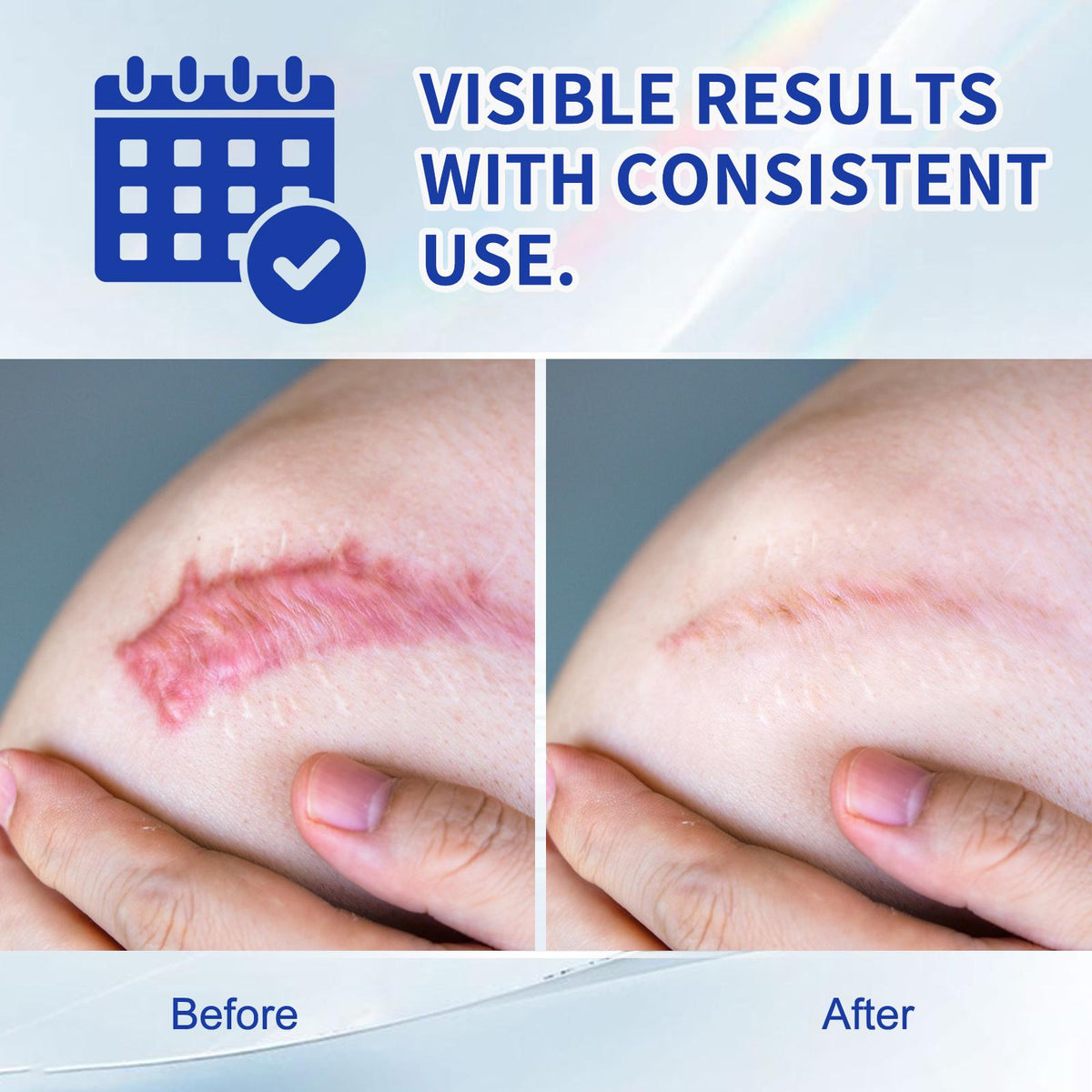Scar Removal Gel for Old and New Scars