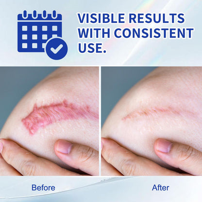 Scar Removal Gel for Old and New Scars